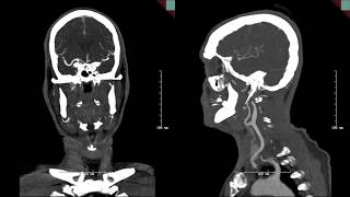 Endovascular mgmt of basilar artery occlusion secondary to fusiform aneurysm w intraluminal thrombus [upl. by Cirda]