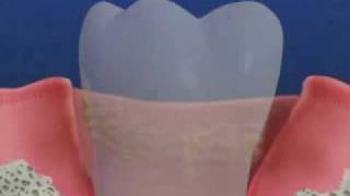 Periodontal Disease amp Treatment [upl. by Saleme]