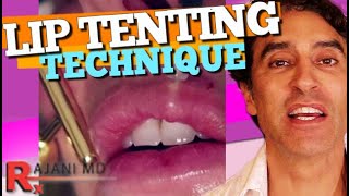 LIP FILLER RUSSIAN TENTING TECHNIQUE Demonstrated  Lip Filler Before and After [upl. by Htnamas]