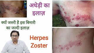 Herpes Zoster Diagnosis amp Treatment अधेड़ी का इलाज़  क्यों जरुरी है इस बिमारी का जल्दी इलाज़ Herpes [upl. by Irrek]