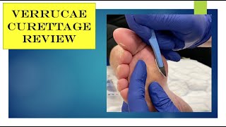 Video  verrucae curettage review [upl. by Araas82]