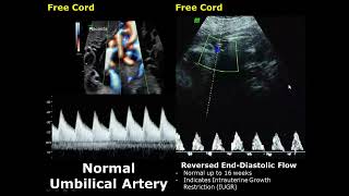 Umbilical Artery Doppler Ultrasound Normal Vs Abnormal Image Appearances  Spectral Doppler USG [upl. by Notsirk845]