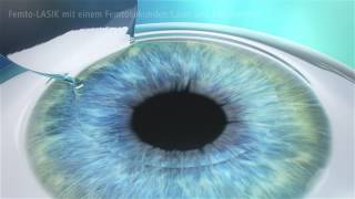 Femto LASIK  die sanfte und sichere LASIK [upl. by Berthold]