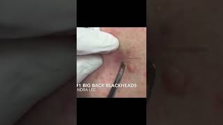 Dr Pimple Poppers Throwback Pops [upl. by Richela]