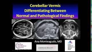 AIUM Webinar Cerebellar Vermis [upl. by Desberg]