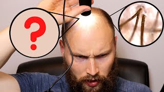 Balding Hair vs quotNormalquot Hair  Miniaturization In Male Pattern Baldness [upl. by Akemak]