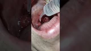 Tonsil Stone Removal using Water Irrigation to Reduce Irritation [upl. by Annot]