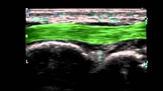 Musculoskeletal Ultrasound Wrist 4 dorsal longitudinal scan median [upl. by Peih]