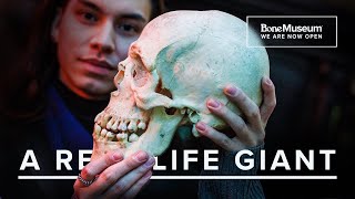 WE HAVE A GIANT Exploring the Rare Condition of Gigantism  The Bone Museum [upl. by Inerney801]