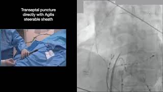 Step by step approach Trans septal puncture with agilis EPStudy AF ablation [upl. by Temme]