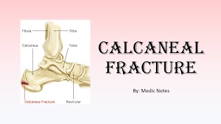 Calcaneal fracture  clinical features Sanders classification investigation treatment [upl. by Kristoffer]