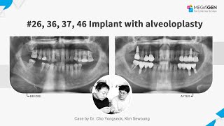 Dr Yongseok CHO Sewoung KIM 26363746 implant with alveoloplasty [upl. by Tessi]