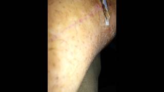 Scab removal [upl. by Teri]