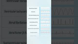 Some Important ECG Rhythms in Cardiac Monitor [upl. by Raama]