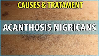 What is Acanthosis Nigricans Causes Symptoms and Treatments [upl. by Garzon424]