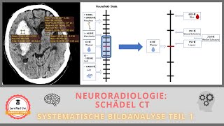 CT Schädel die richtige FensterTechnik bei der Bildanalyse [upl. by Drona665]