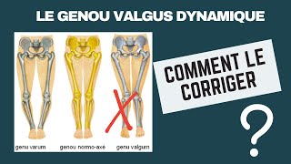 genoux valgus [upl. by Nirol]