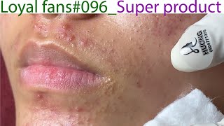 Acne Treatment Huong Da Nang 096  Loyal fans  Super product [upl. by Eentruok]