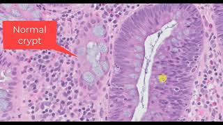 The Diagnosis of a Tubular Adenoma [upl. by Llennaj]