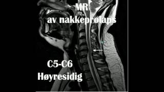 MR undersøkelse av nakkeprolaps prolaps i C5C6 C6C7 [upl. by Aremat3]