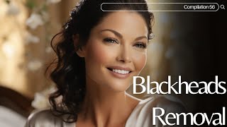 Skincare  Blackheads Removal 056 skincare skincare blackheads blackheads [upl. by Aritak793]