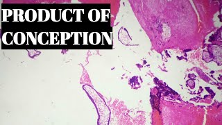 Product Of Conception Histopathology [upl. by Nitz]