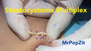 Steatocystoma multiplex extractions Creamy butter cyst pops Ingrown hairs Many more coming soon [upl. by Nauwtna798]