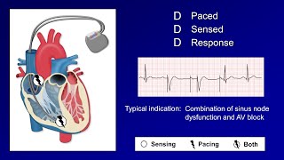 Pacemaker Modes and Settings [upl. by Calabrese]