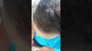 PRP Therapy Before and After Result drprateeksharma eveite hairtransplant cosmeticsurgery [upl. by Papagena584]