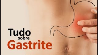 TUDO SOBRE GASTRITE  SINAIS SINTOMAS E TRATAMENTO  Dr Marcelo Lima [upl. by Navets]