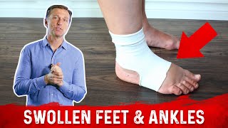 Foods for Fluid Retention in the Feet and Ankles – DrBerg [upl. by Anele]