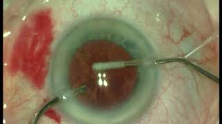 Parkinsons Head Tremor amp Phacoemulsification Cataract Surgery amp IOL Implant [upl. by Engelhart]