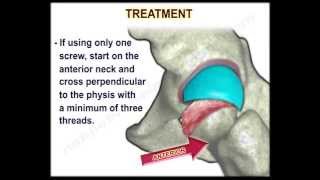 Slipped Capital Femoral Epiphysis  Everything You Need To Know  Dr Nabil Ebraheim [upl. by Assirok359]