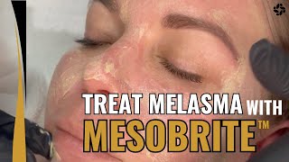 Treat Melasma With MesoBrite™ [upl. by Xanthus89]