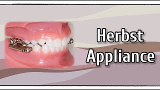 Herbst Appliance [upl. by Bartlett]