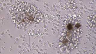 TIL  Tumor Infiltrating Immunotherapy TREATMENT [upl. by Eejan]