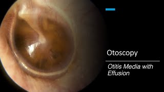 Otitis Media with Effusion Otoscopy [upl. by Pelligrini]