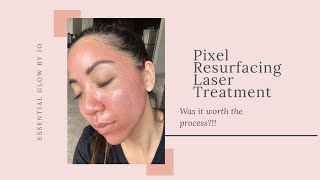 Pixel Resurfacing Laser Treatment  Was it worth the process [upl. by Nwhas]