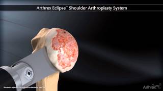 Arthrex Eclipse Shoulder Arthroplasty System [upl. by Bencion]