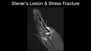 Steners Lesion amp Stress Fracture [upl. by Annalise]