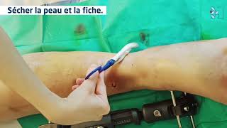 Tuto 1 Fixateur Externe [upl. by Mufinella]