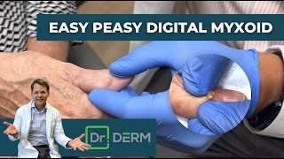 Easy Peasy Digital Myxoid  Dr Derm [upl. by Ihcehcu]