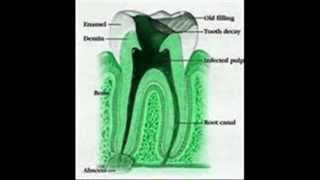 Periodontitis apical aguda [upl. by Wiley]