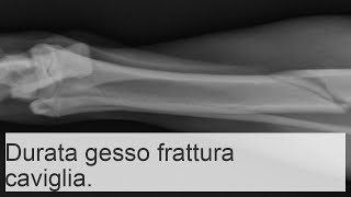 Frattura della caviglia con e senza spostamento quanto tempo bisogna camminare con il gesso [upl. by Annavahs]