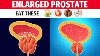 Treat Benign Prostatic Hyperplasia with These Natural Remedies [upl. by Mattias]