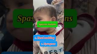 Spasmus nutans syndrome  Head nodding in babies [upl. by Attennot]