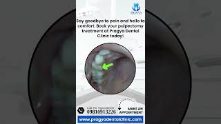 Periapical Abscess Treatment Pulpectomy at Pragya Dental Clinic [upl. by Ydaj]