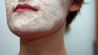 Face Eczema  Atopic Dermatitis  Eczema Dermatitis Rash Treatment [upl. by Vidovik]