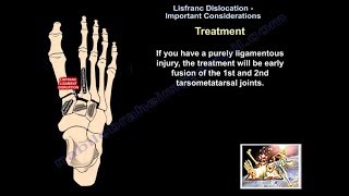 Lisfranc Dislocation Important Considerations  Everything You Need To Know  Dr Nabil Ebraheim [upl. by Dine]