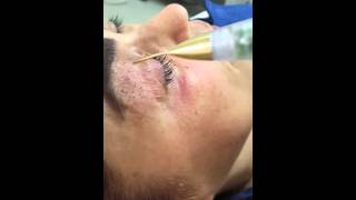 Jett Plasma Lift Medical  Blepharoplasty noninvasive [upl. by Yanal833]